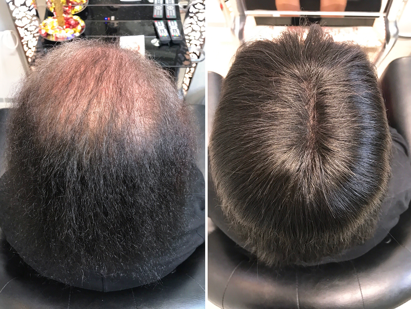 https://hairtalk.ru/wp-content/uploads/2021/12/Нарастили-систему-замещения-волос-Wonder-Fill-основа-16-на-125-см-длина-волос-25-см-тон-1-4.jpg